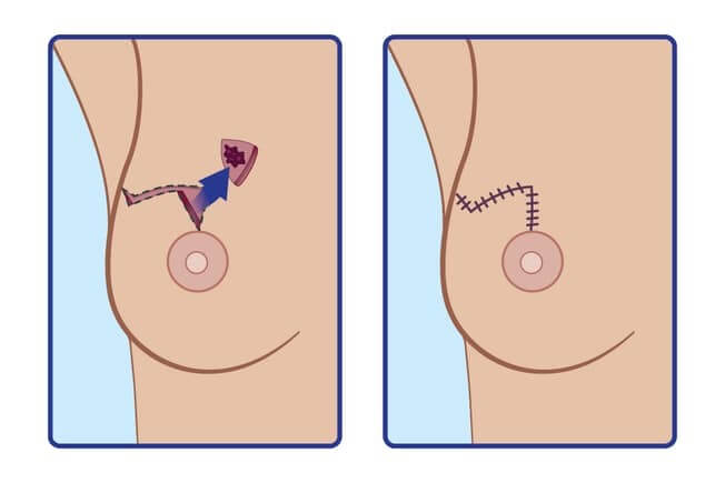 10 نکته ای که باید در مورد جراحی انکوپلاستیک سینه بدانید 10 نکته ای که باید در مورد جراحی انکوپلاستیک سینه بدانید