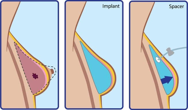 10 نکته ای که باید در مورد جراحی انکوپلاستیک سینه بدانید 10 نکته ای که باید در مورد جراحی انکوپلاستیک سینه بدانید